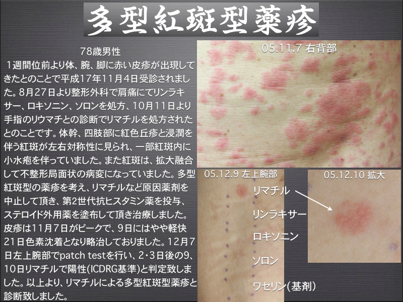 播種状紅斑丘疹型中毒疹 – 薬疹 中毒疹の症状 治療方法について – WCXGQ
